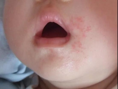 宝宝进食后嘴巴周围泛红，是过敏了吗?